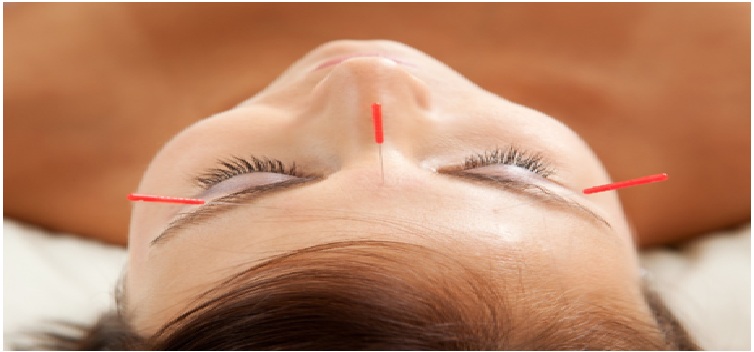 Acupuncture Services