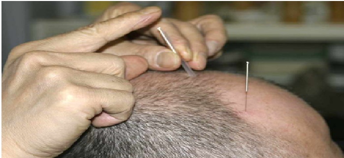 Advanced Acupuncture Treatment in Pune